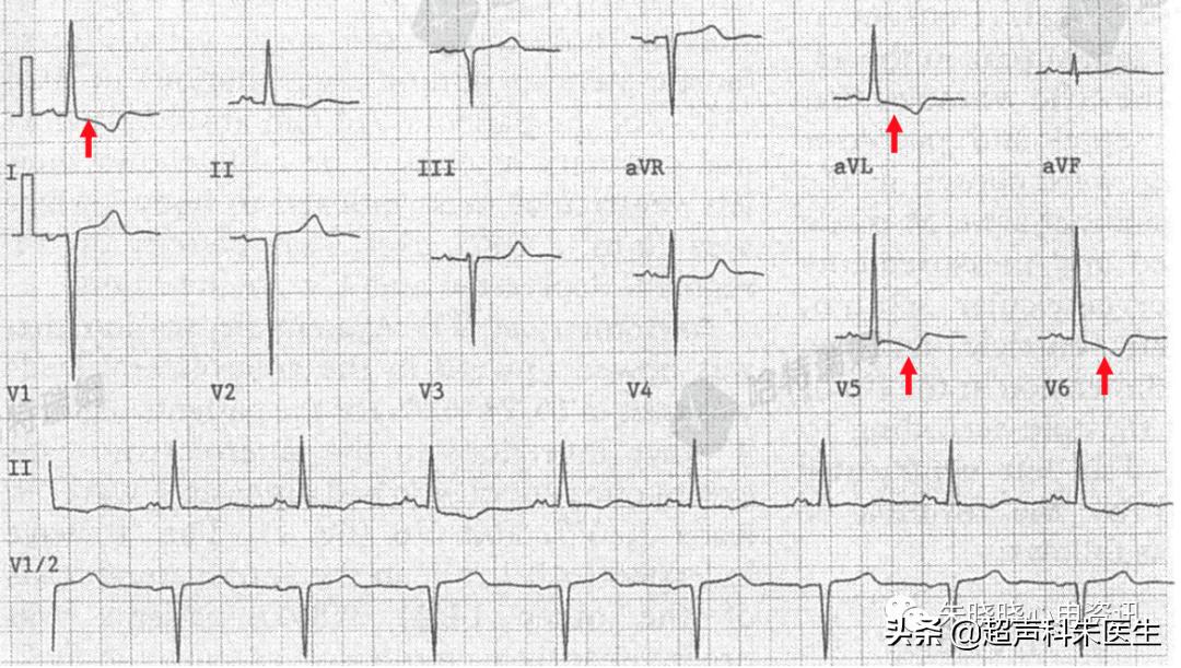 t波倒置诊断,t波倒置如何区分严重程度
