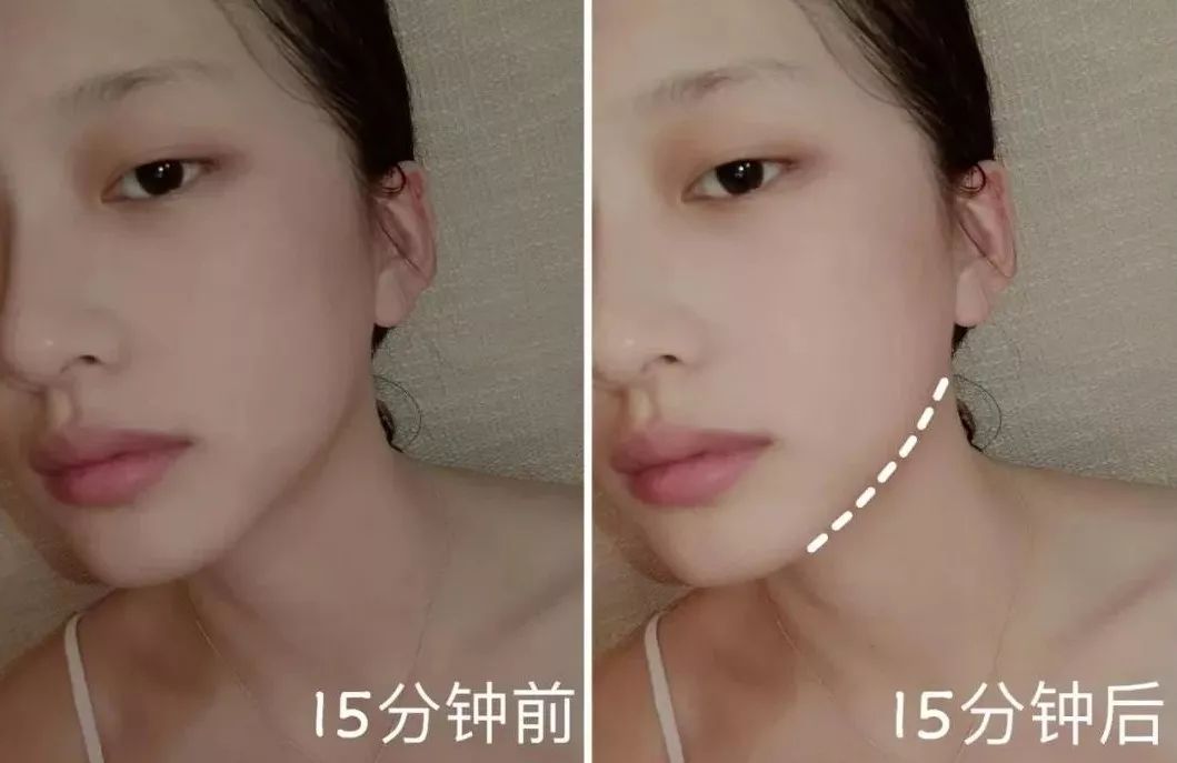 大饼脸用什么减肥方法,减肥圆脸变v字脸效果好吗