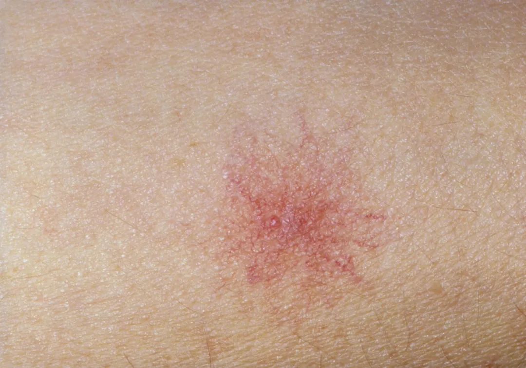 过敏身上突然长了小红点是啥原因,身上突然出现小红点不痛不痒图片