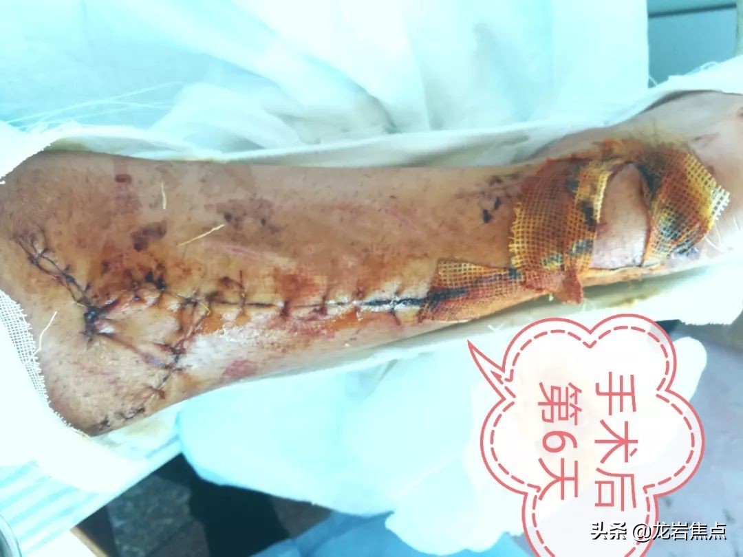 整块皮没了怎么处理,整块皮肤没了会增生吗