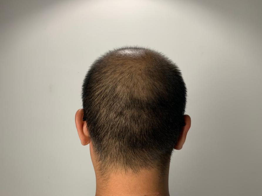 怎么样不脱发掉发,不脱发头发软细少怎么办