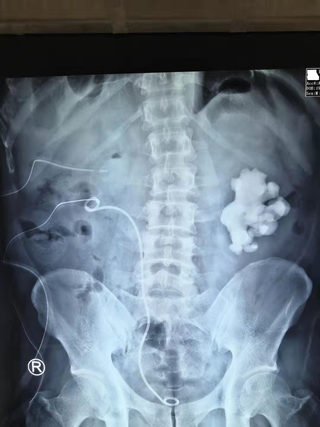 疯狂的石头除藻,肾结石鹿角形状的结石什么样