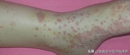 过敏性紫癜留下的色素沉着怎么治,过敏性紫癜出血点都在什么位置