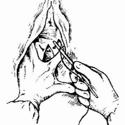 女性分娩时真的都需要“剪下面”吗？妇产科医生说了实话，别错过