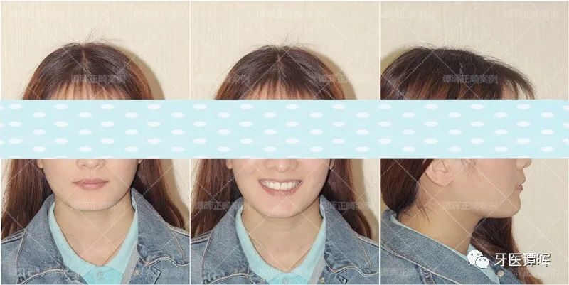 门牙前突+牙齿不齐矫正案例分享