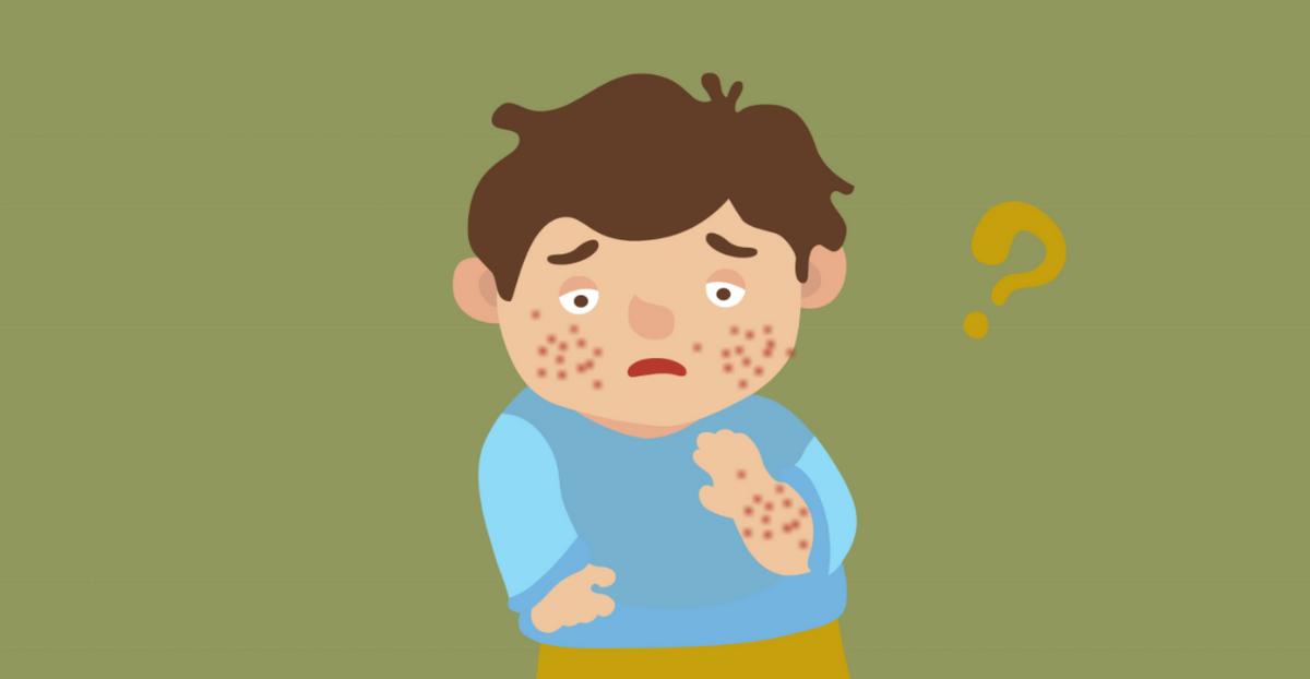 什么是过敏性紫癜症状,过敏性紫癜什么症状怎么治疗