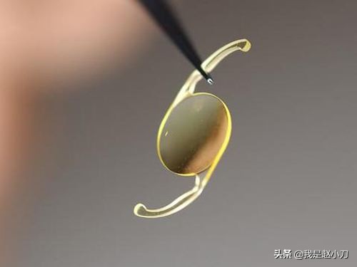 当今世界白内障手术,白内障手术为什么那么多钱