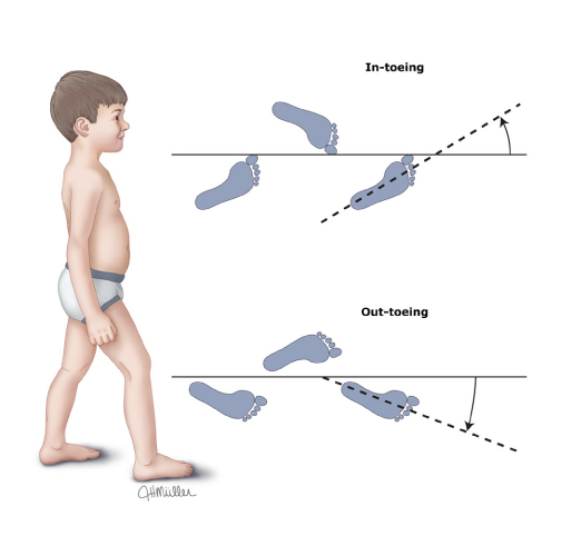 小孩子走路内八字要不要干预,婴儿走路内八字需要治疗吗