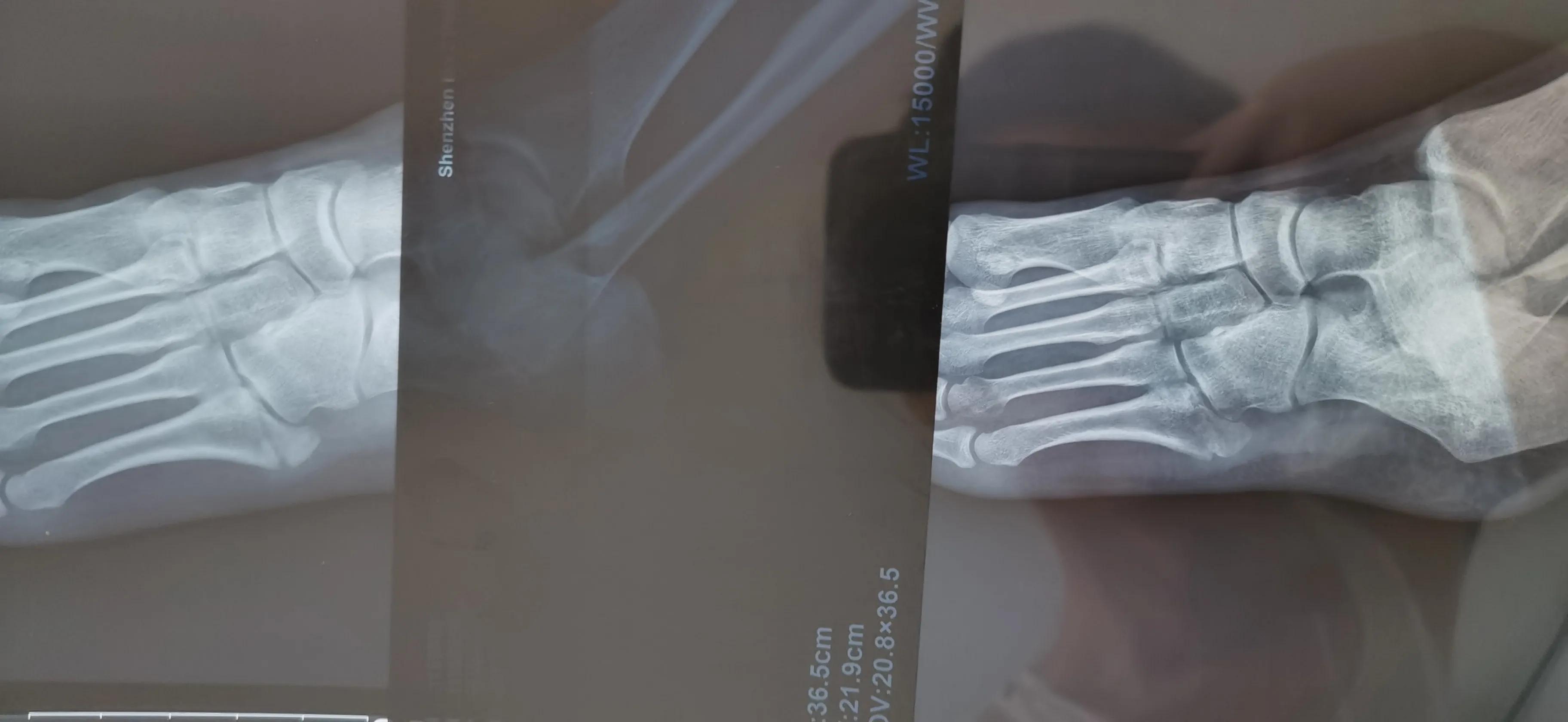 第五跖骨粉碎性骨折多久后能走路,第五跖骨基底骨折100天了走路肿