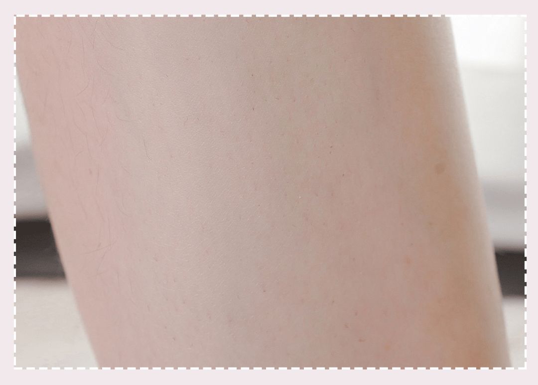 体毛脱毛的效果怎么样,天生体毛旺盛的人正常吗