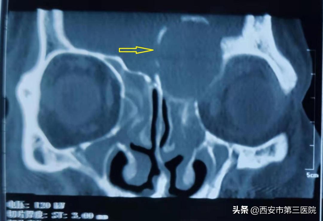 治愈鼻窦炎有好的方法么,鼻窦炎反复发作疼痛难以忍受