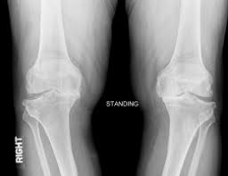 膝关节骨性关节炎的预防,怎么预防骨性关节炎