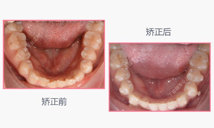 单颗牙隐形矫正,郑州隐形矫正牙齿哪家便宜