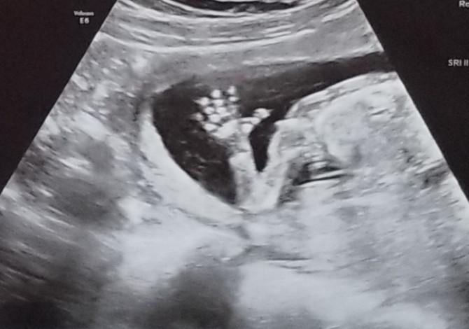 美国女教师难孕后检查出双子宫第二年幸运怀孕成功产女