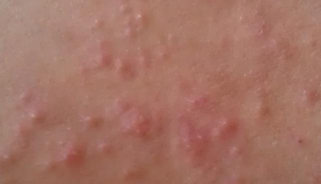 湿疹严重有什么忌口,湿疹过来人的独家秘籍