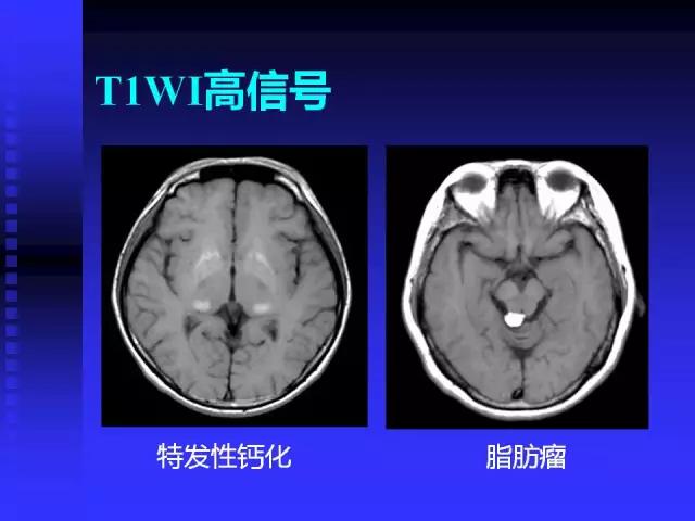 头颅mri读片视频教程,颅脑mri读片入门教程视频讲解全集