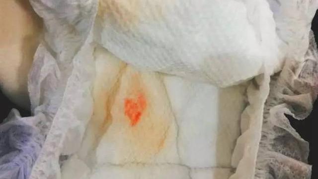 女宝宝下身有血丝是怎么回事,女婴下身有血丝怎么办
