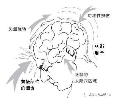 脑震荡应该注意事项,脑震荡需要什么休养方式保养