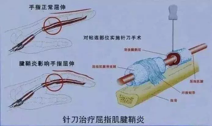 手指肌腱水肿怎么办,腱鞘炎手指肿胀怎么治最好