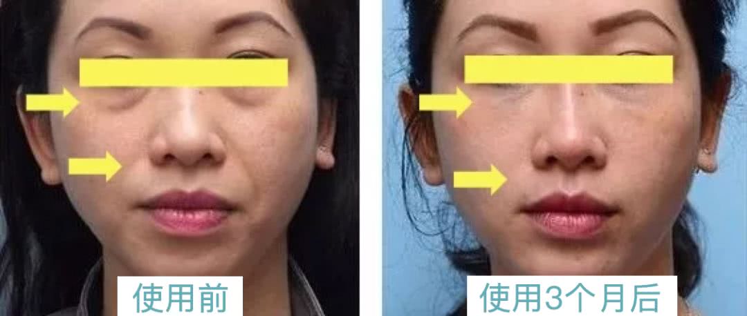 微整的真实效果,微整蜕变过程