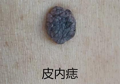 痣用点么,痣能点么