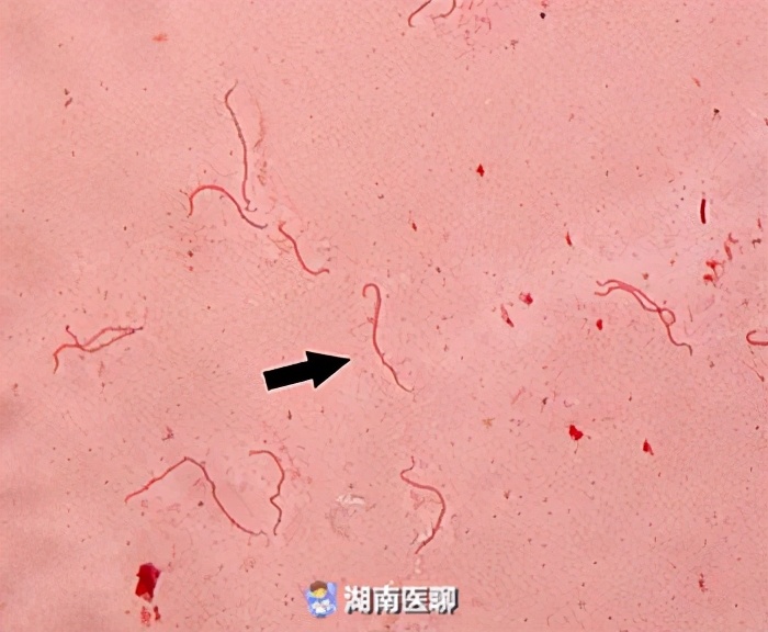 只因喝了一口田间水！花季女孩“感冒”发热，竟致中毒性休克