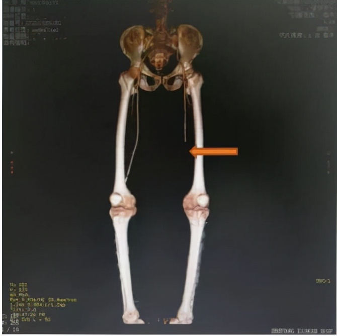 下肢动脉闭塞会导致脚疼吗,下肢动脉闭塞脚趾发麻