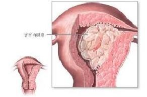 哪来的那么多“内膜增厚”