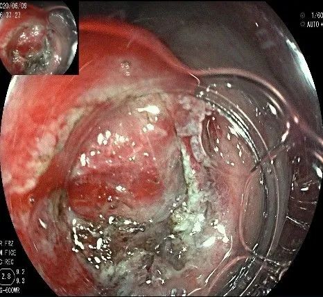 贲门处见隆起性病变,贲门高级别瘤变esd术后不能吃什么