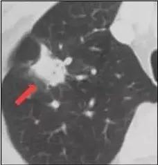 肺结节无任何症状中医治疗肺结节,体检查出肺结节莫慌中医有妙招