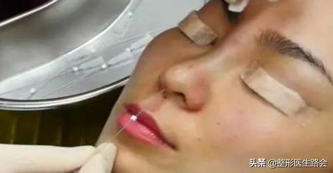 线雕隆鼻的问题,线雕隆鼻的后遗症多久出现