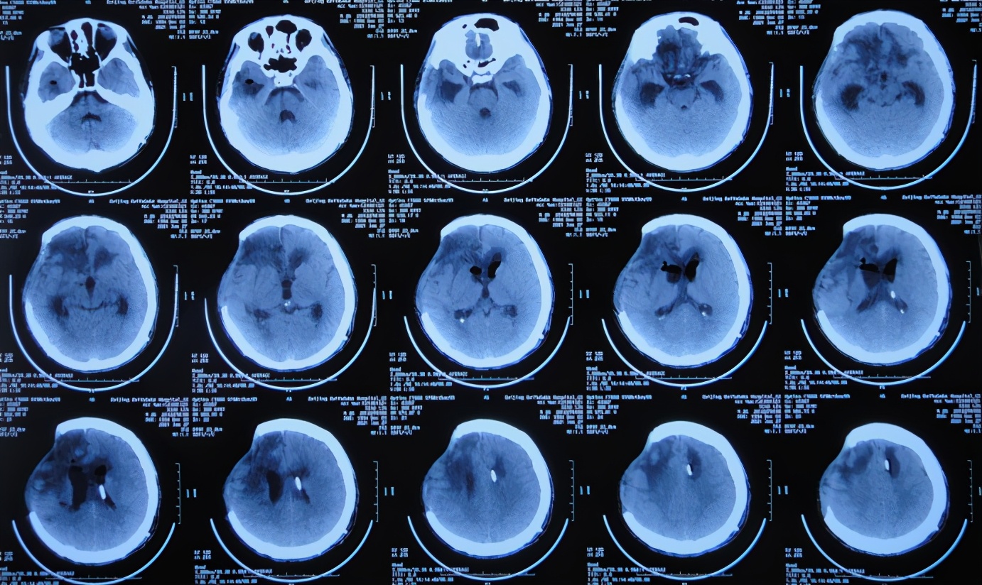 开颅手术后颅内细菌感染图片,外伤开颅手术后脑积液能恢复吗