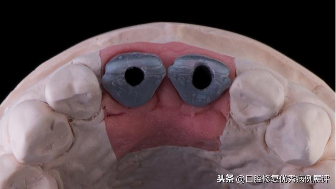 展评优秀病例赏析|Asc全瓷角度基台一体冠进行种植前牙美学修复