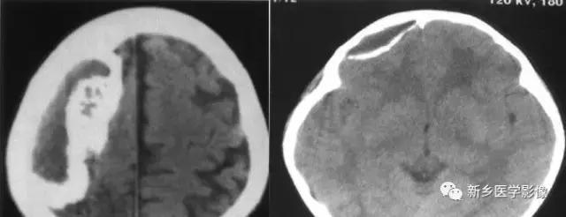 颅内有钙化怎么治疗,34岁脑部有钙化正常吗