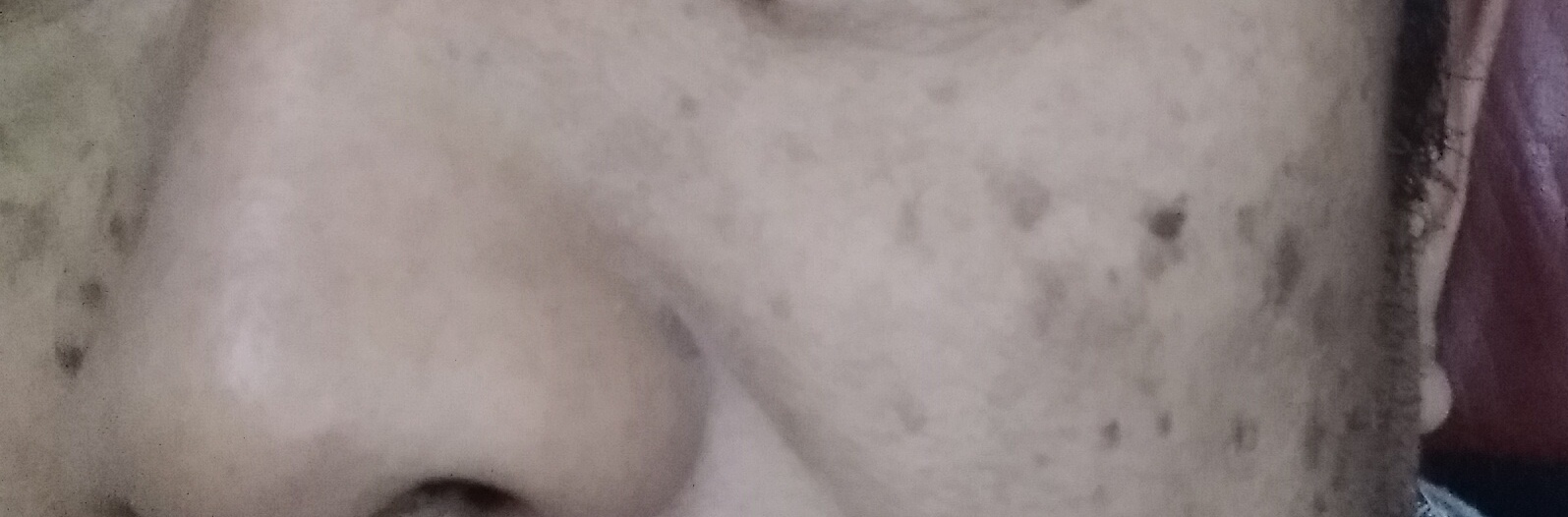 油溅到脸上有黑斑多久消失图片,脸上有老年黑斑怎么治