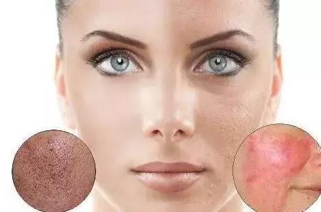 痘印很顽固怎么祛痘印,痘印祛痘药膏