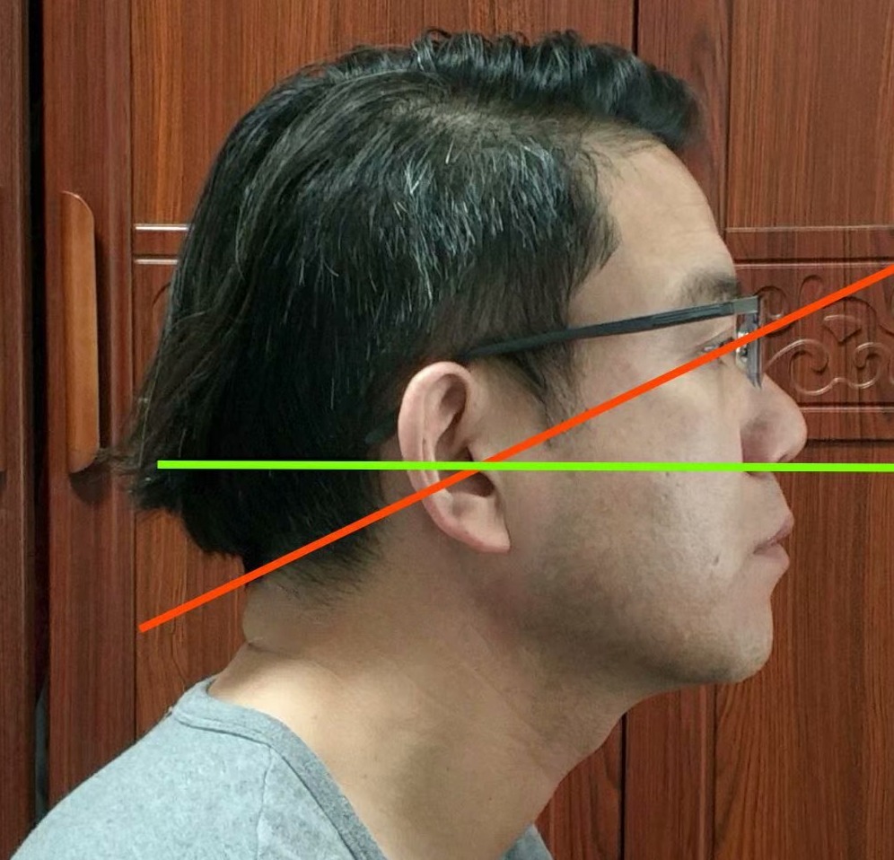 颈椎富贵包怎么做操可以缓解,颈椎突出一个包怎么快速恢复