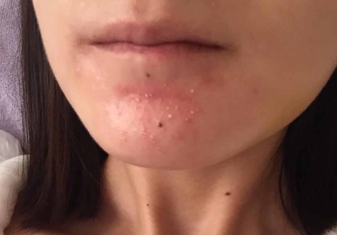 下巴上长疮怎么治疗,下巴长疮的快速治疗方法