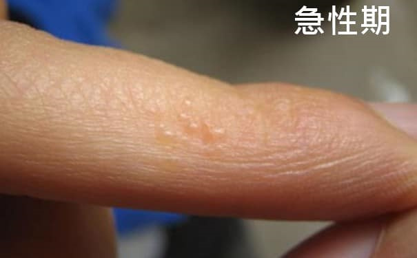 吃巧克力孩子会过敏吗,吃巧克力小孩会增加黑色素吗