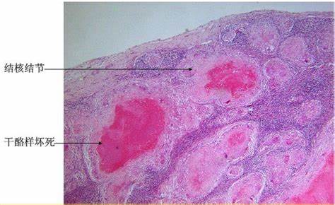 怀疑肺结核一定要查三次痰吗,医生怀疑是肺结核的几率有多大