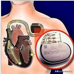 反复心慌心悸是什么原因,心悸心慌发作时应怎么缓解