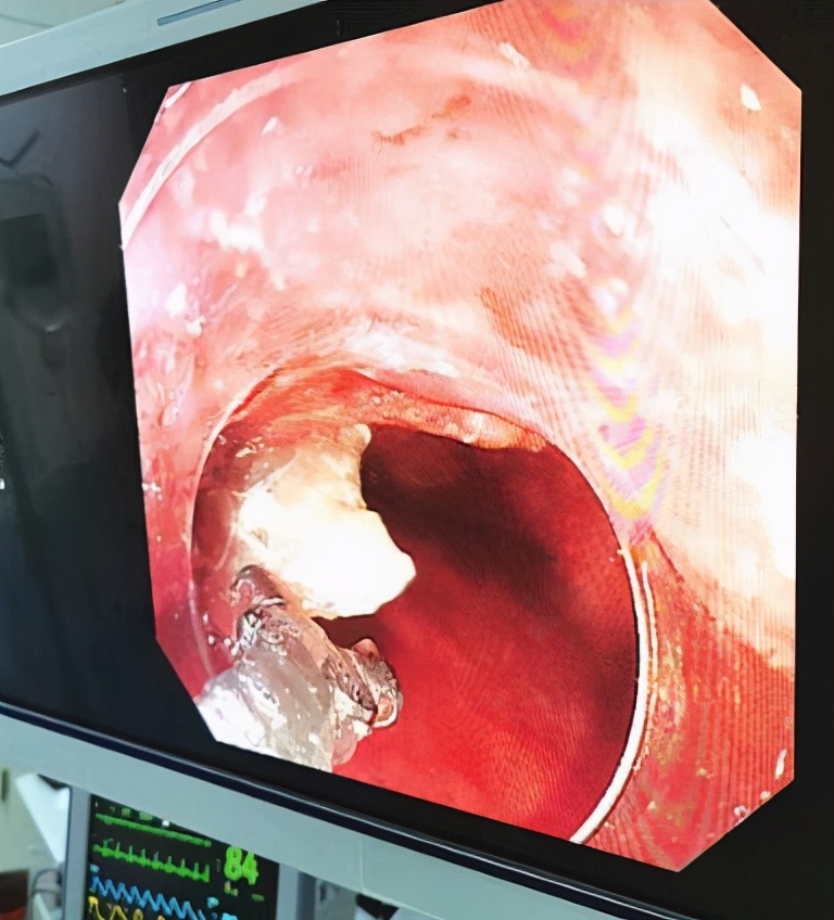 鱼刺卡喉咙女子后续,喉咙内窥镜检查取鱼刺