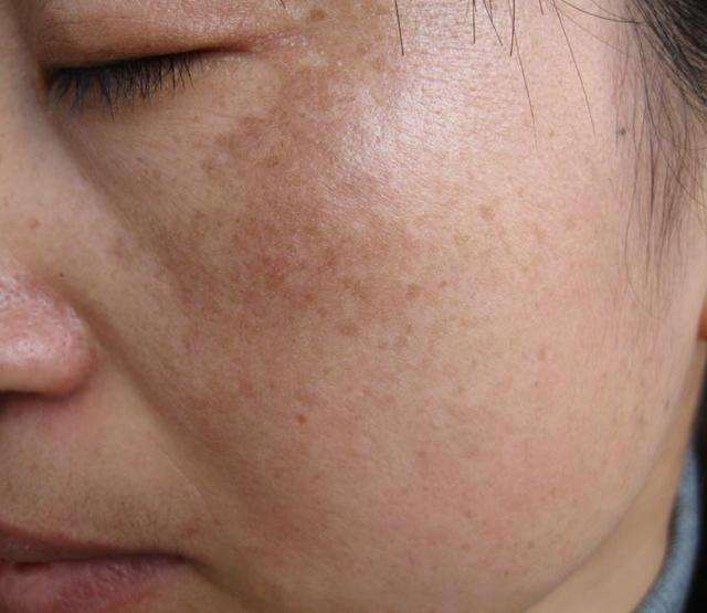 我脸上全是斑怎么回事,我脸上的斑多有什么好方法吗