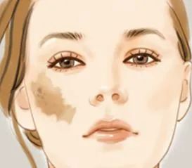 脸部长斑是什么原因,脸部长斑是什么原因导致的