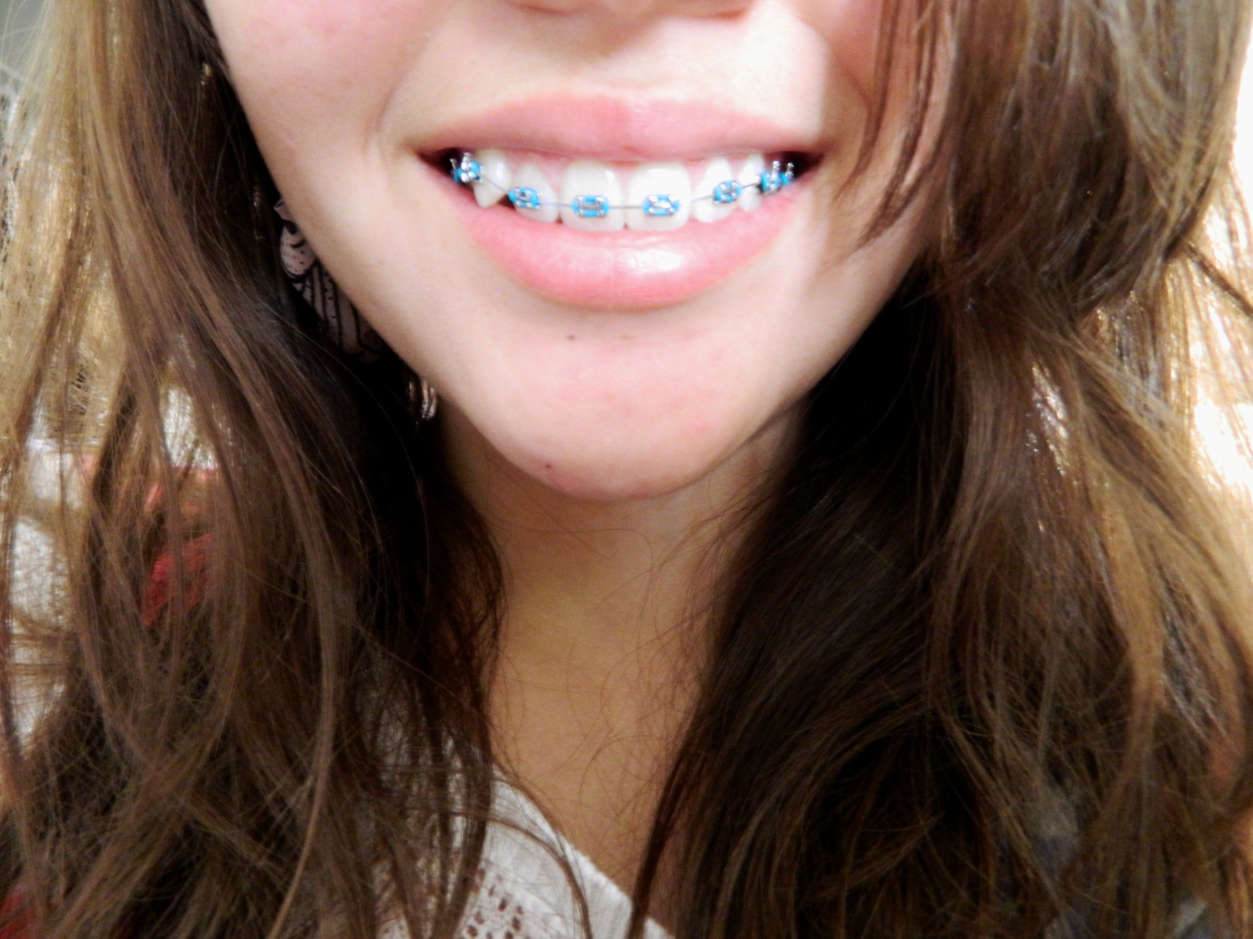 正畸后有反弹迹象怎么办,正畸矫正后反弹怎么办