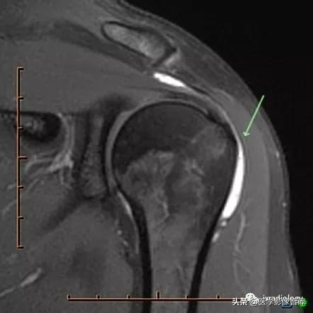 肩关节滑膜解剖,肩关节周围肌肉解剖