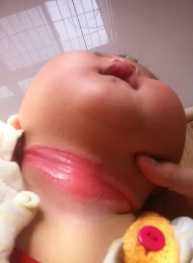 宝宝脖子淹了破皮了可以用茶油吗,宝宝淹脖子破皮能用红霉素软膏吗