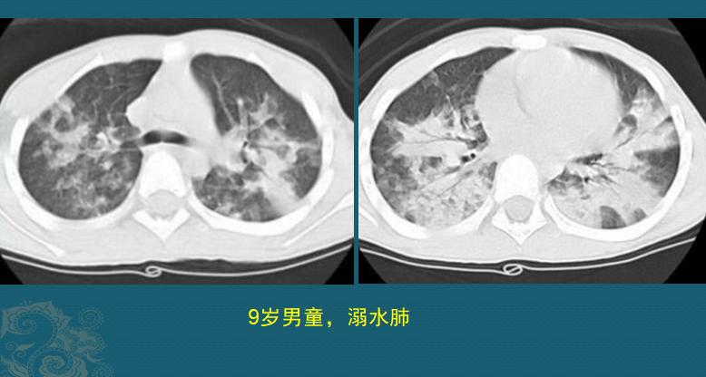 溺水后肺里有积水吗,溺水后肺里的水会出来吗