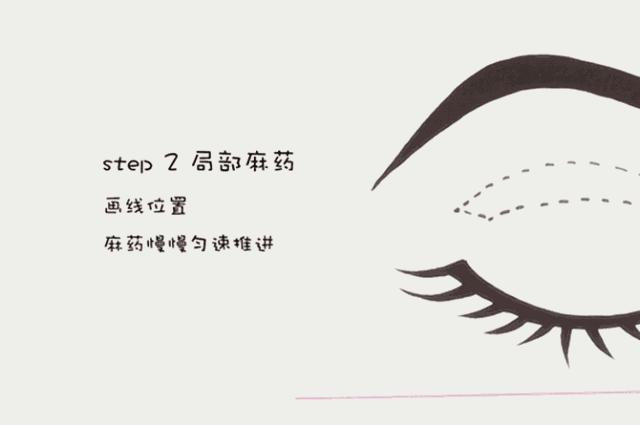 全切无痕割双眼皮,全切双眼皮原来是这么割出来的