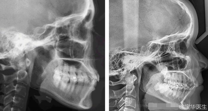正畸矫正骨性难还是牙性难,正畸和正颌